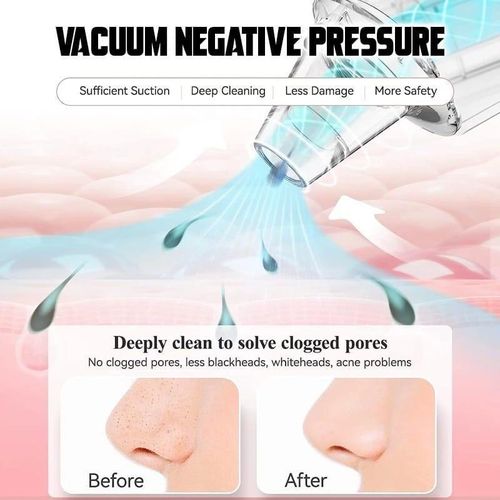 4-in-1 Blackhead Remover Machine – Derma Suction Pore Vacuum Cleaner