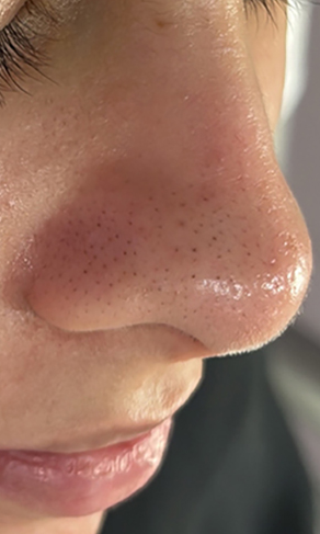 Before 5-in-1 Blackhead Remover