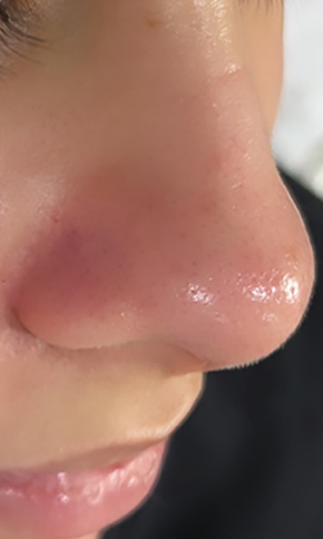 After 5-in-1 Blackhead Remover