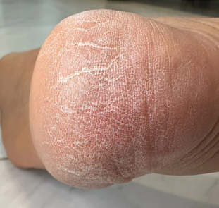 Before Electric Foot File Grinder