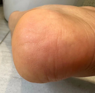 After Electric Foot File Grinder